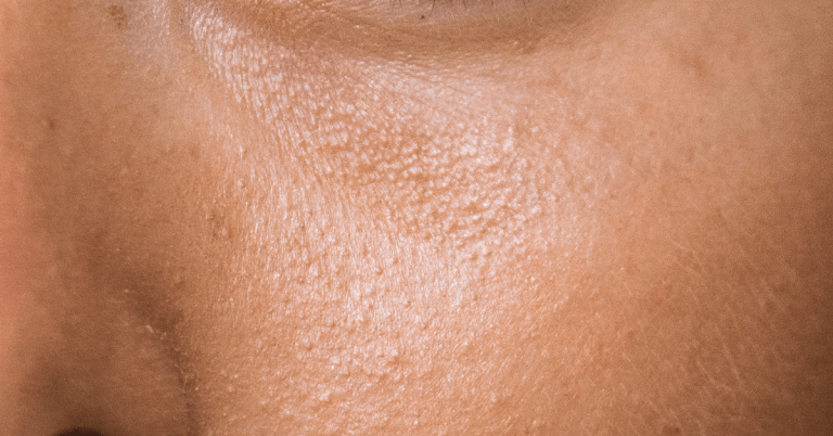 How can I treat oily skin